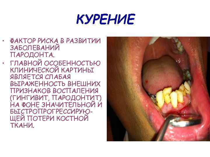 КУРЕНИЕ • ФАКТОР РИСКА В РАЗВИТИИ ЗАБОЛЕВАНИЙ ПАРОДОНТА. • ГЛАВНОЙ ОСОБЕННОСТЬЮ КЛИНИЧЕСКОЙ КАРТИНЫ ЯВЛЯЕТСЯ