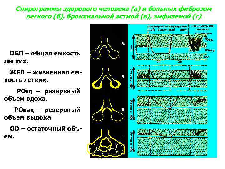 Спирограммы здорового человека (а) и больных фиброзом легкого (б), бронхиальной астмой (в), эмфиземой (г)