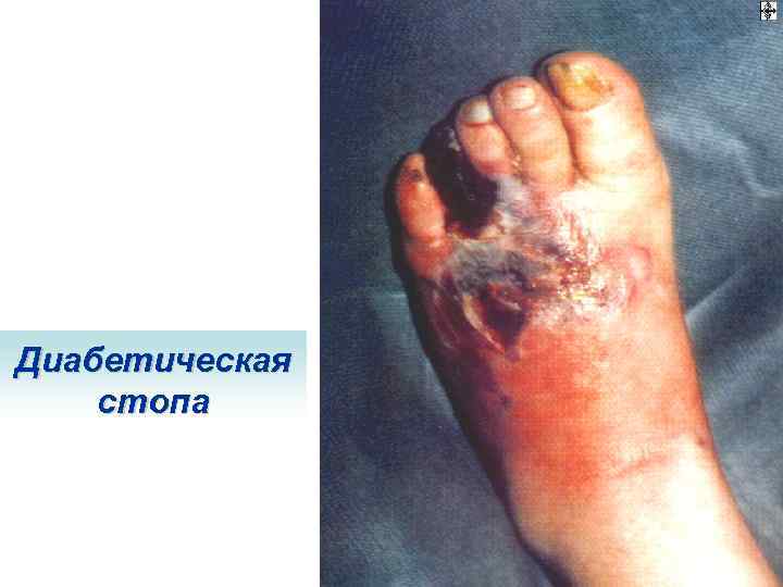 Диабетическая стопа 