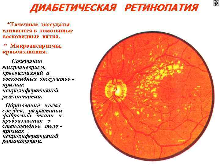 ДИАБЕТИЧЕСКАЯ РЕТИНОПАТИЯ *Точечные экссудаты сливаются в гомогенные восковидные пятна. * Микроаневризмы, кровоизлияния. Сочетание микроаневризм,