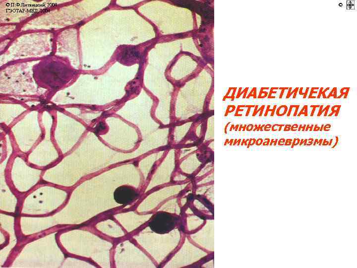 © П. Ф. Литвицкий, 2004 ГЭОТАР-МЕД, 2004 © ДИАБЕТИЧЕКАЯ РЕТИНОПАТИЯ (множественные микроаневризмы) 