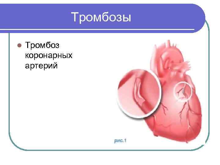    Тромбозы l  Тромбоз коронарных артерий 