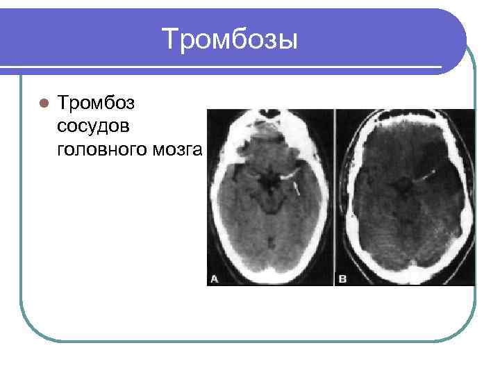 Тромбоз артерии мозга. Тромбоз головных сосудов. Тромб в сосуде головного мозга. Тромбоз поверхностных вен головного мозга.