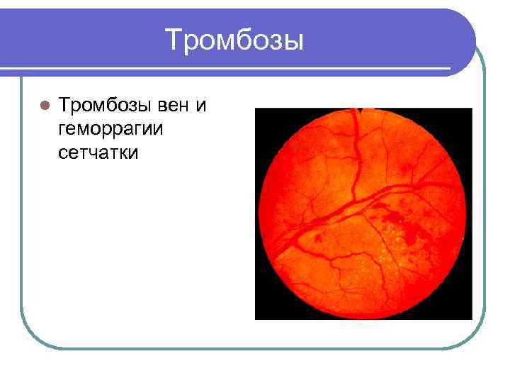    Тромбозы l  Тромбозы вен и геморрагии сетчатки 