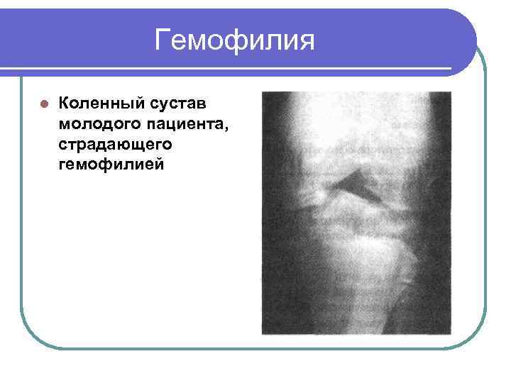    Гемофилия l  Коленный сустав молодого пациента, страдающего гемофилией 