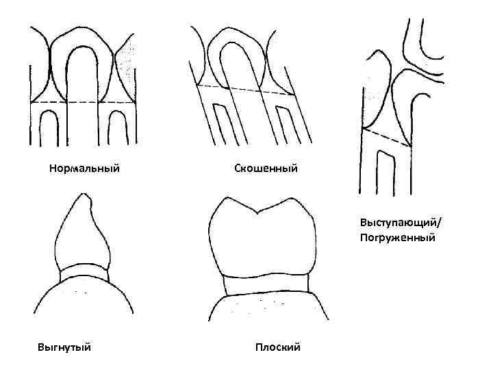 Нормальный Скошенный Выступающий/ Нормальный Скошенный Выступающий/