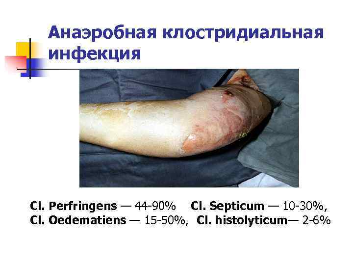  Анаэробная клостридиальная  инфекция Сl. Perfringens — 44 -90% Cl. Septicum — 10
