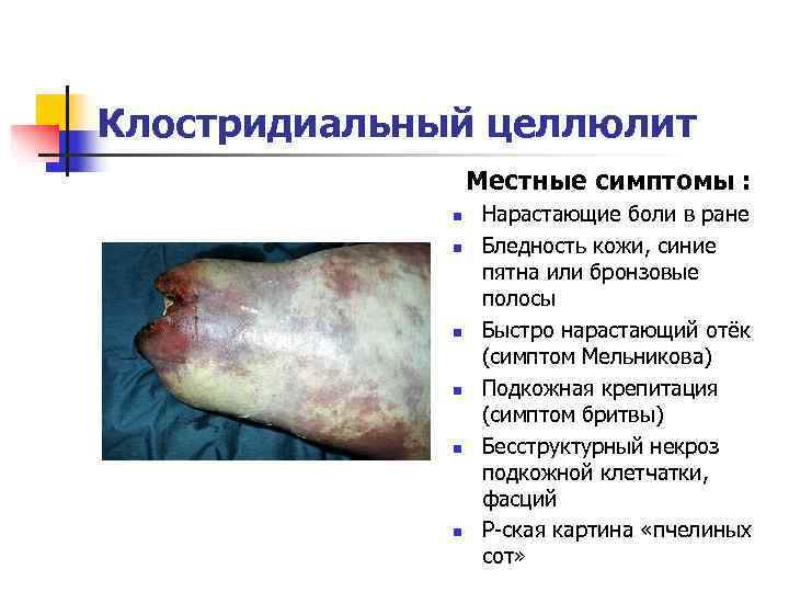 Клостридиальный целлюлит    Местные симптомы :    n  Нарастающие