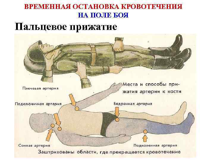 Схема пальцевого прижатия артерий при кровотечении