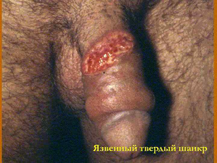 Язвенный твердый шанкр 