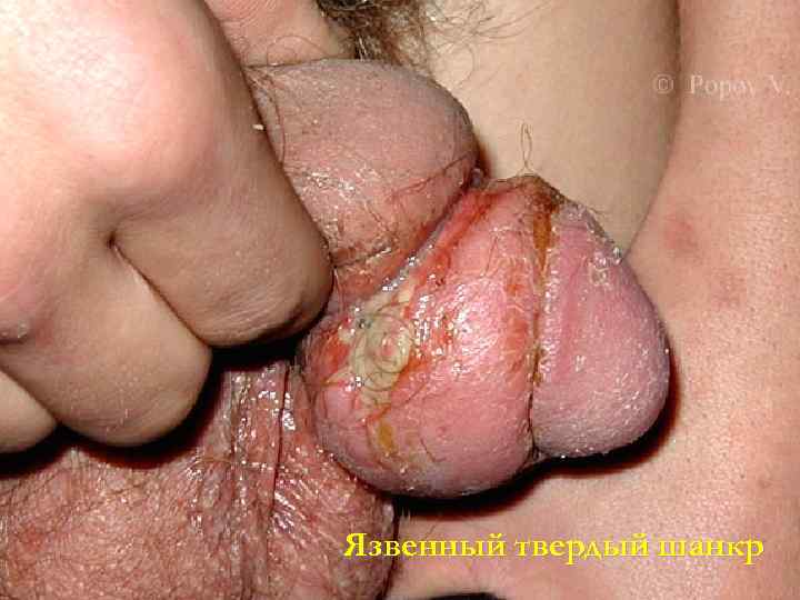 Язвенный твердый шанкр 