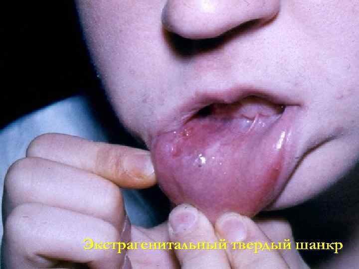 Экстрагенитальный твердый шанкр 