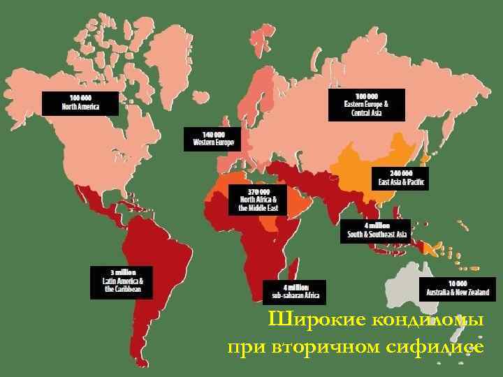  Широкие кондиломы при вторичном сифилисе 