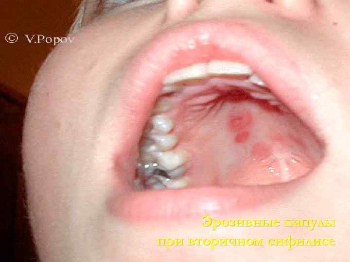  Эрозивные папулы при вторичном сифилисе 