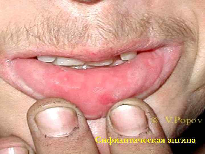 Сифилитическая ангина 