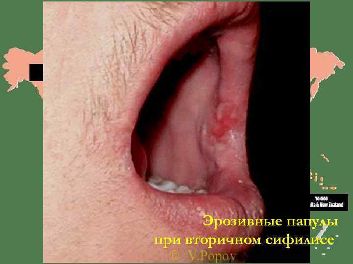  Эрозивные папулы при вторичном сифилисе 