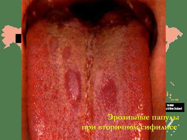  Эрозивные папулы при вторичном сифилисе 