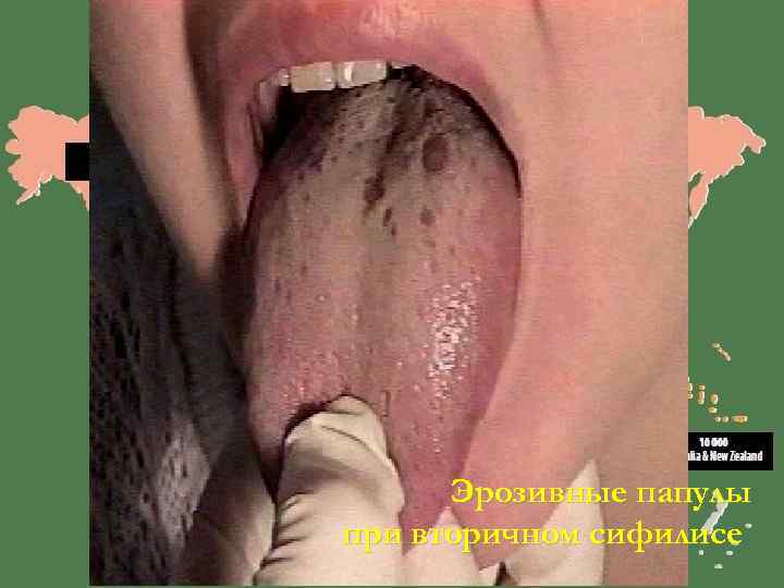  Эрозивные папулы при вторичном сифилисе 