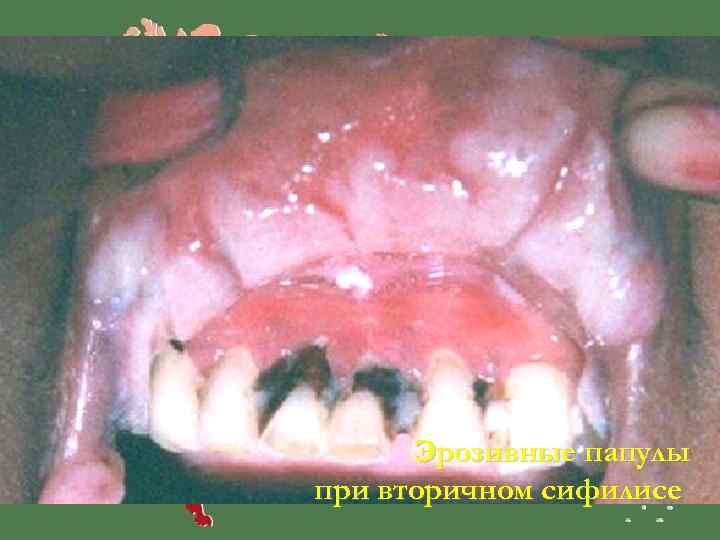  Эрозивные папулы при вторичном сифилисе 