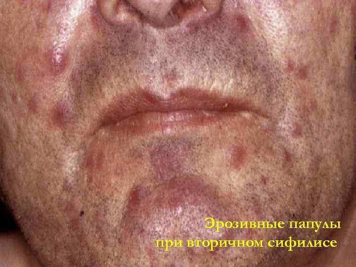  Эрозивные папулы при вторичном сифилисе 