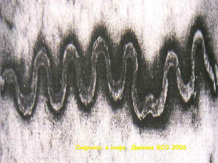 Сифилис в мире. Данные ВОЗ 2006 