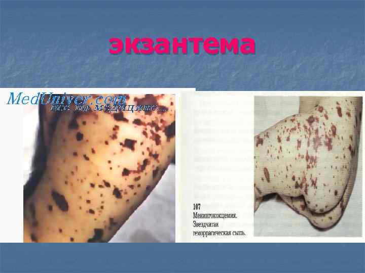 экзантема 