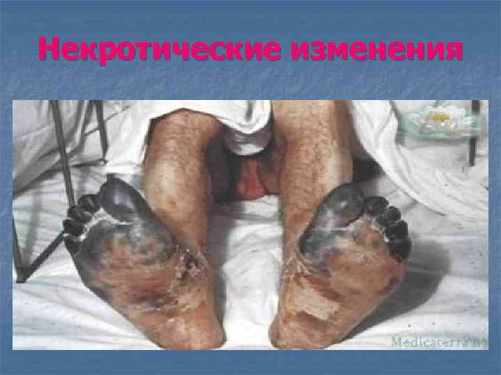 Некротические изменения 
