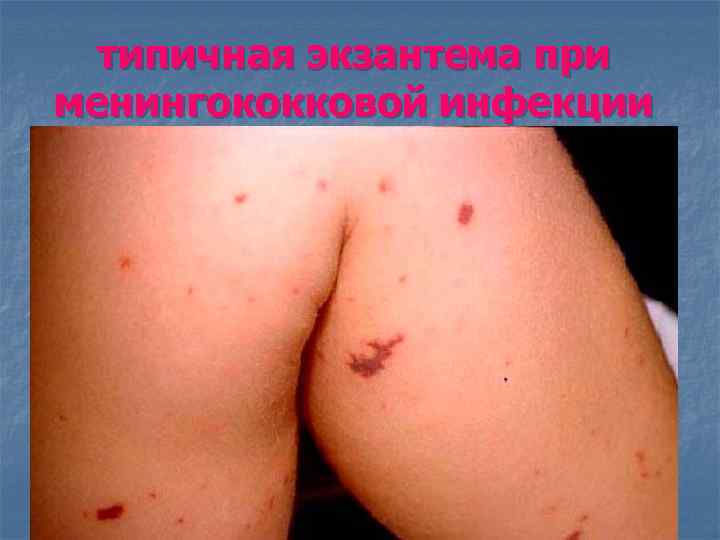  типичная экзантема при менингококковой инфекции 
