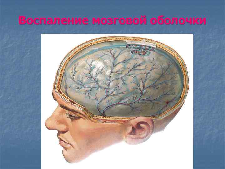 Воспаление мозговой оболочки 