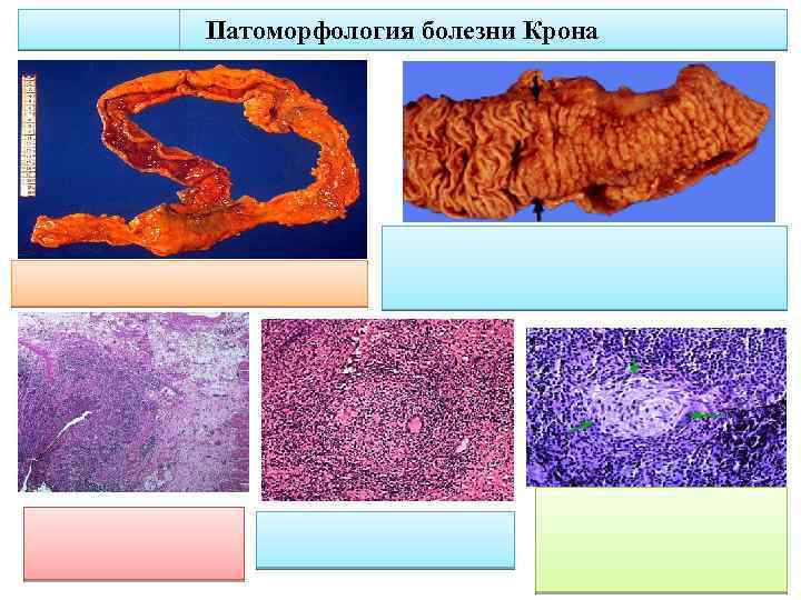 Патоморфология болезни Крона 