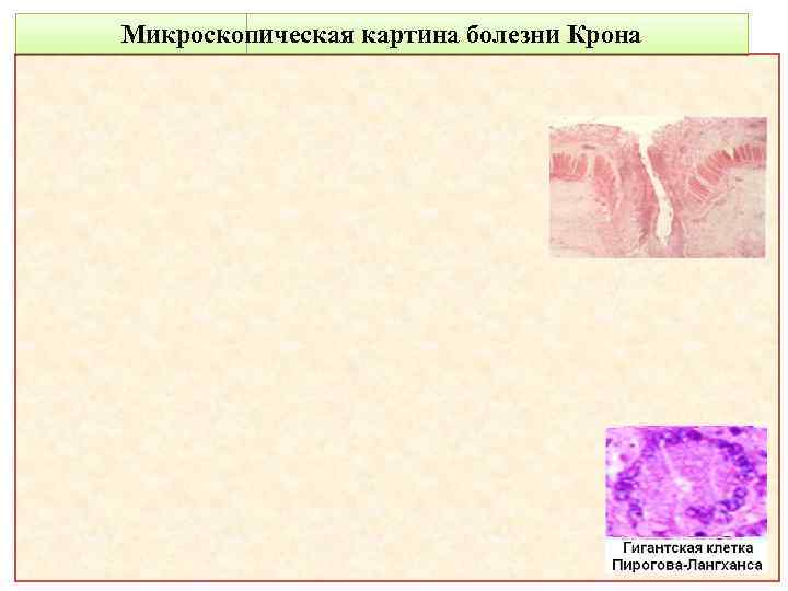 Микроскопическая картина болезни Крона 