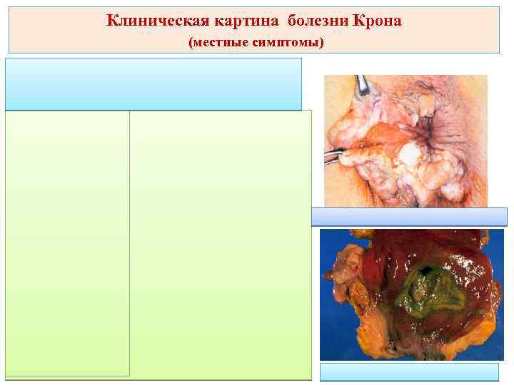 Клиническая картина болезни Крона (местные симптомы) 