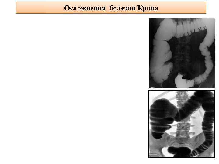 Осложнения болезни Крона 