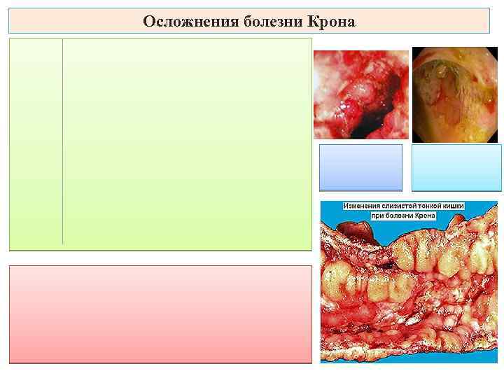 Осложнения болезни Крона 