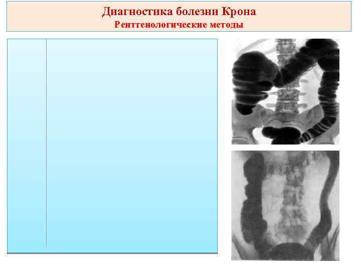 Диагностика болезни Крона Рентгенологические методы 