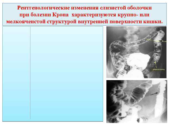 Рентгенологические изменения слизистой оболочки при болезни Крона характеризуются крупно- или мелкоячеистой структурой внутренней поверхности