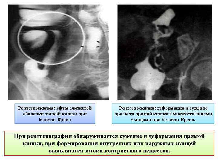 Рентгеноскопия: афты слизистой оболочки тонкой кишки при болезни Крона Рентгеноскопия: деформация и сужение просвета