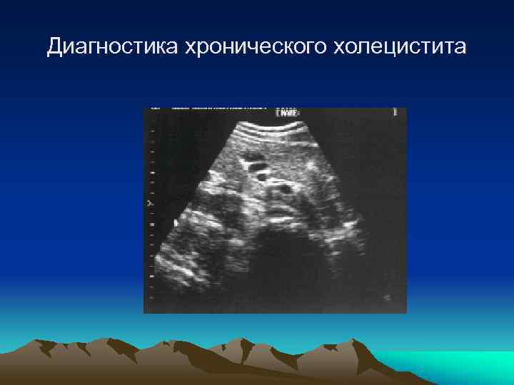 Диагностика хронического холецистита 