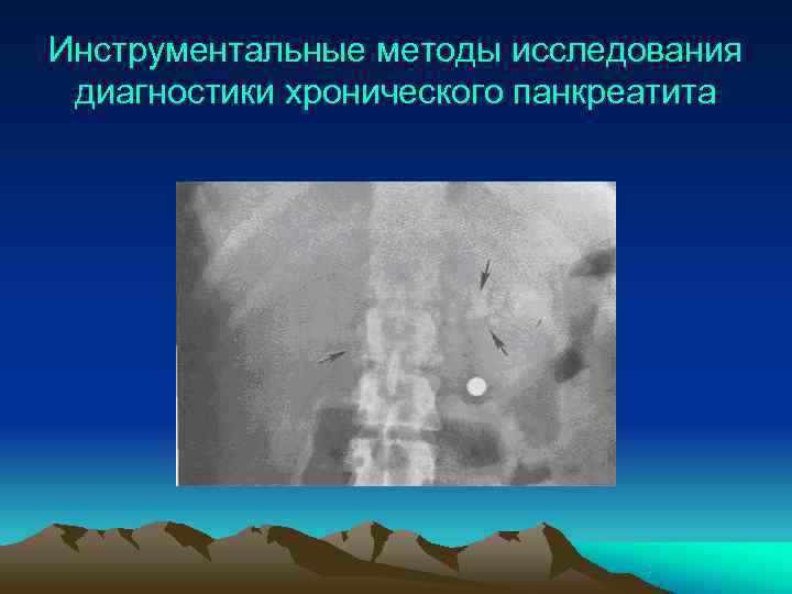 Инструментальные методы исследования диагностики хронического панкреатита 