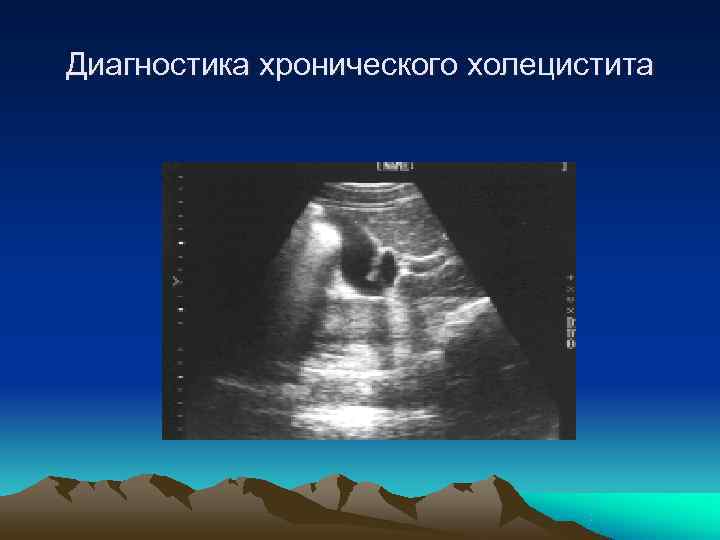 Диагностика хронического холецистита 
