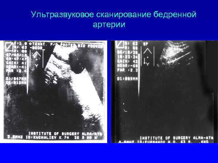 Ультразвуковое сканирование бедренной артерии 