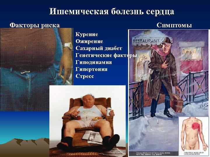 Ишемическая болезнь сердца Факторы риска Симптомы Курение Ожирение Сахарный диабет Генетические факторы Гиподинамия Гипертония