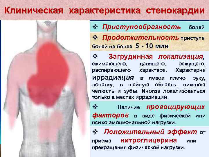 Клиническая характеристика стенокардии v Приступообразность болей v Продолжительность приступа болей не более 5 -