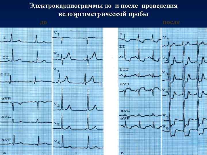 Электрокардиограммы до и после проведения велоэргометрической пробы до после 