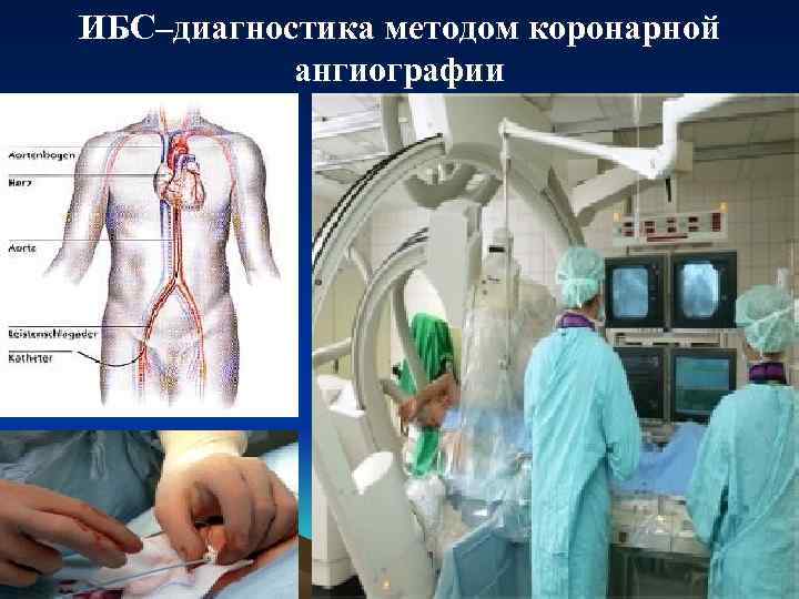 ИБС–диагностика методом коронарной ангиографии 