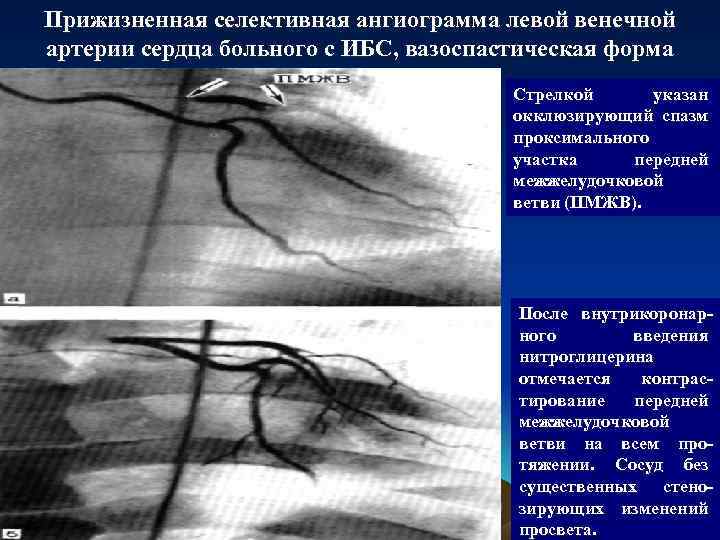Прижизненная селективная ангиограмма левой венечной артерии сердца больного с ИБС, вазоспастическая форма Стрелкой указан
