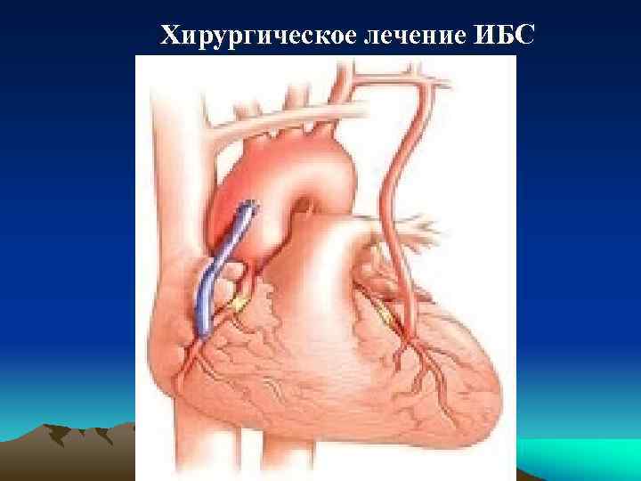 Хирургическое лечение ИБС 