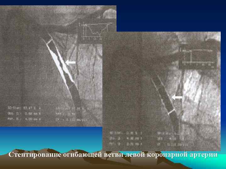 Стентирование огибающей ветви левой коронарной артерии 