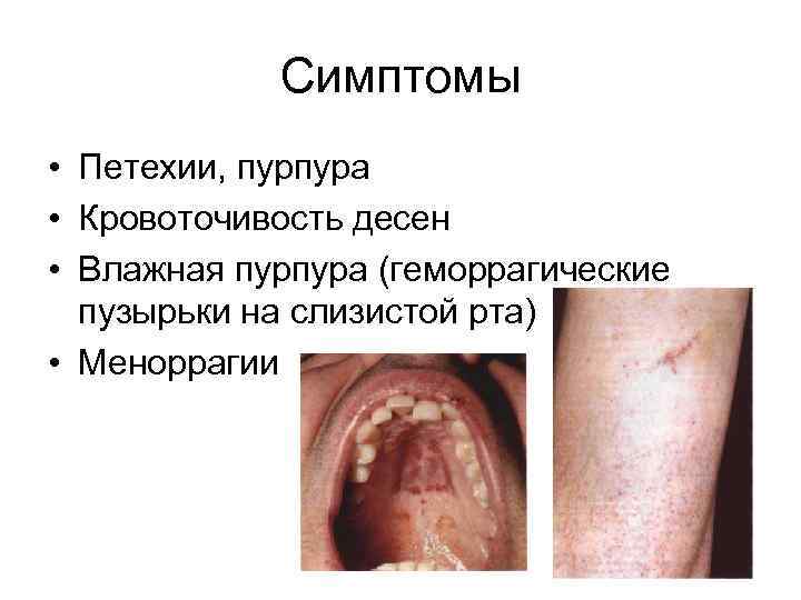 Симптомы • Петехии, пурпура • Кровоточивость десен • Влажная пурпура (геморрагические пузырьки на слизистой