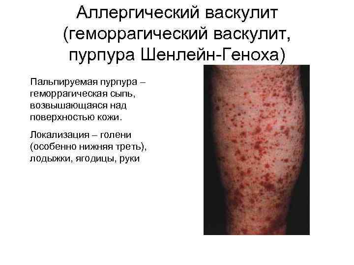 Аллергический васкулит (геморрагический васкулит, пурпура Шенлейн-Геноха) Пальпируемая пурпура – геморрагическая сыпь, возвышающаяся над поверхностью